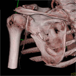 Scapular Fracture - CTisus CT Scan