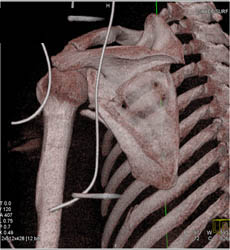 Scapular Fracture - CTisus CT Scan