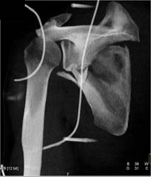 Scapular Fracture - CTisus CT Scan