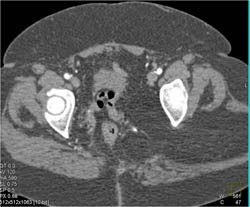 Lipoma Through Sacrosciatic Foramen - CTisus CT Scan