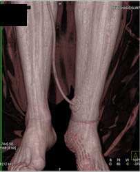 Drain Near Ankle - CTisus CT Scan