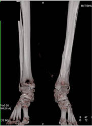 Chronic Stasis - CTisus CT Scan