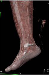 Tibial Fracture - CTisus CT Scan