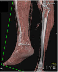 Tibial Fracture - CTisus CT Scan