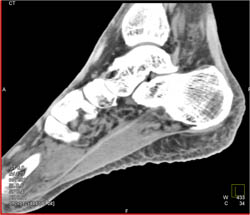 Soft Tissue Edema - CTisus CT Scan