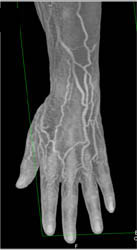 Cellulitis - CTisus CT Scan