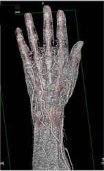 Cellulitis - CTisus CT Scan