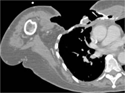 Abscess in Chest Wall Debrided - CTisus CT Scan