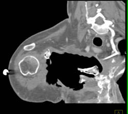 Extensive Debridement of An Abscess - CTisus CT Scan