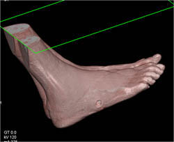 Ulceration of the Foot - CTisus CT Scan