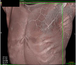 Cellulitis - CTisus CT Scan