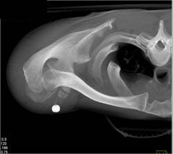 Normal S/c Joint - CTisus CT Scan