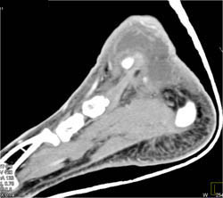 GSW With Sacral Fracture and Intact Bladder and Rectum - CTisus CT Scan