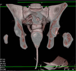 Sacral Fracture - CTisus CT Scan