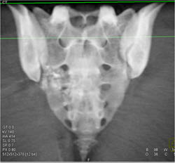 Sacral Fracture - CTisus CT Scan