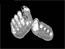 Gas Gangrene and Osteomyelitis - CTisus CT Scan