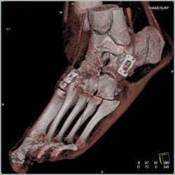 Fusion Ankle - CTisus CT Scan