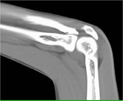 Joint Effusion Elbow Joint - CTisus CT Scan