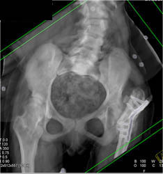 Repair of Left Slipped Capital Femoral Epiphysis (SCFE) - CTisus CT Scan