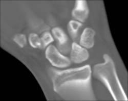 Lunate Dislocation - CTisus CT Scan