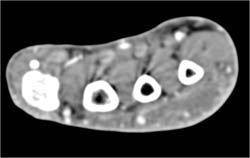 Cellulitis - CTisus CT Scan