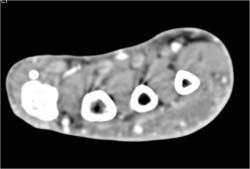 Cellulitis - CTisus CT Scan