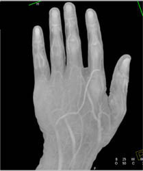 Cellulitis - CTisus CT Scan