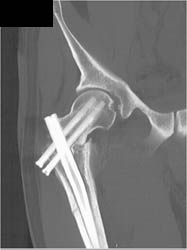 Pins in Femur - CTisus CT Scan