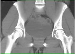 Small Joint Fragment Near Left Hip - CTisus CT Scan