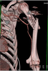 Humerus Fracture - CTisus CT Scan