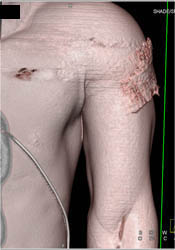 Humerus Fracture - CTisus CT Scan