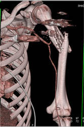 Humerus Fracture - CTisus CT Scan