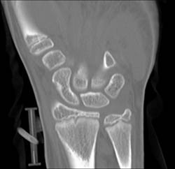 Scaphoid Fracture - CTisus CT Scan