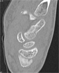 Scaphoid Fracture - CTisus CT Scan