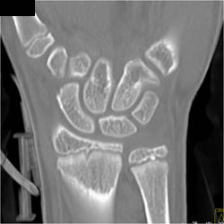 Scaphoid Fracture - CTisus CT Scan