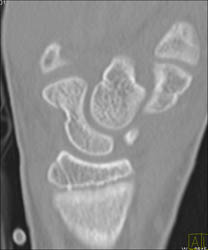 Scaphoid Fracture - CTisus CT Scan