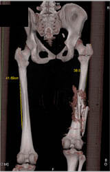 Femur Fracture - CTisus CT Scan