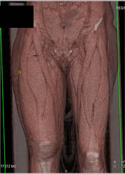 Femur Fracture - CTisus CT Scan