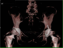 Intact Bilateral Total Hip Replacements (THRs) - CTisus CT Scan