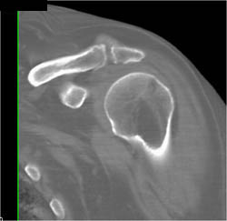 Degenerative Joint Disease (DJD) Shoulder - CTisus CT Scan