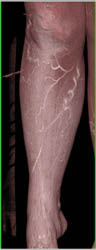 Collaterals and Cellulitis - CTisus CT Scan