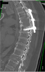 Myeloma - CTisus CT Scan