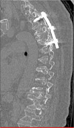 Myeloma - CTisus CT Scan