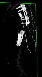 Myeloma - CTisus CT Scan