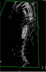 Myeloma - CTisus CT Scan