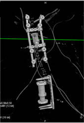 Myeloma - CTisus CT Scan