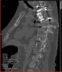 Myeloma - CTisus CT Scan