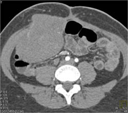 Desmoid Tumor in Gardners Syndrome - CTisus CT Scan