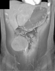 Desmoid Tumor - CTisus CT Scan