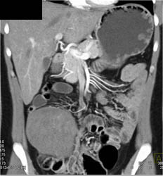 Desmoid Tumor RLQ and Gastric Polyps - CTisus CT Scan